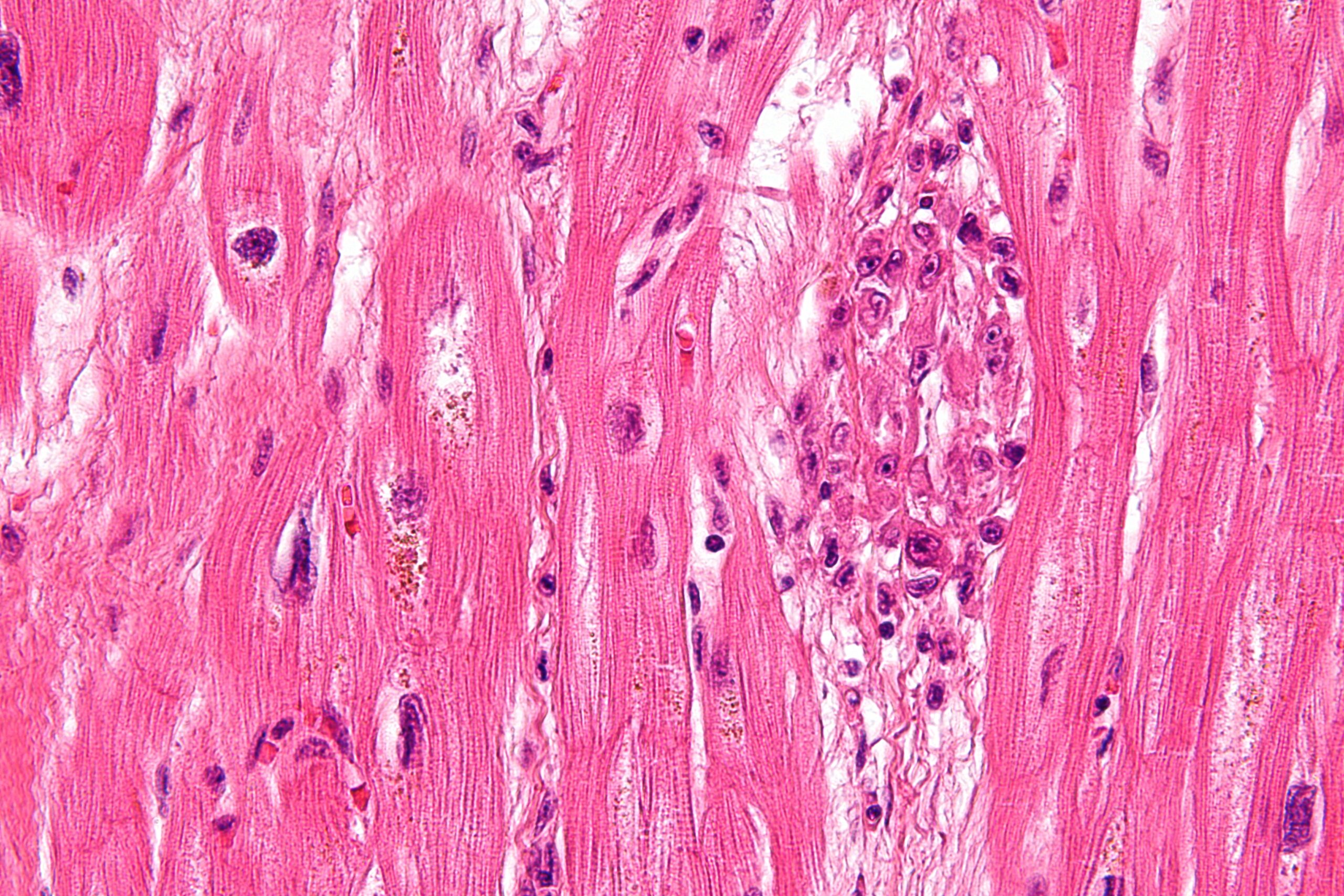 Rheumatic Fever Vaccine On The Cards Expert Reaction Science Media 