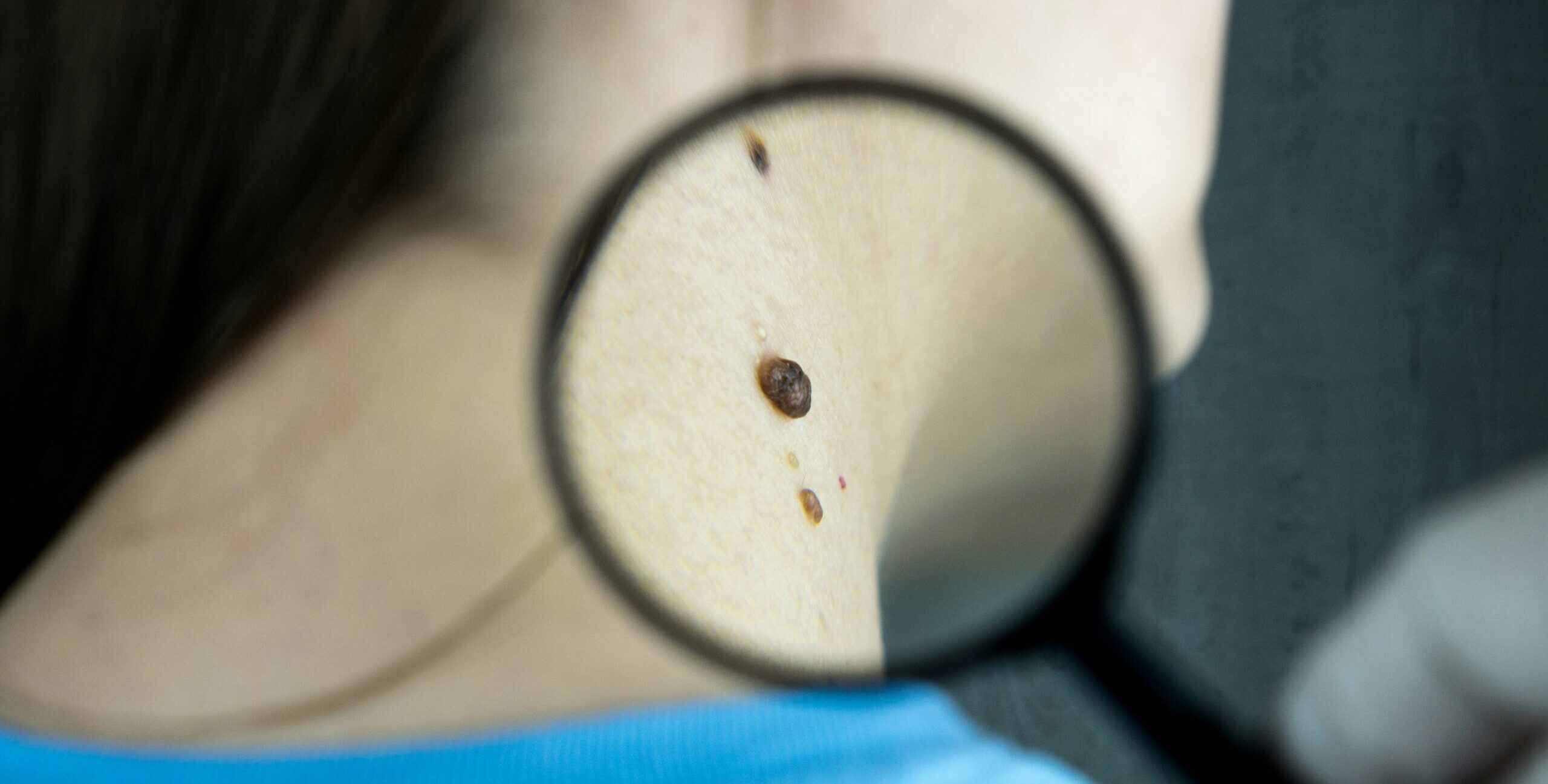 Melanoma vaccine trial shows promising results – Expert Reaction